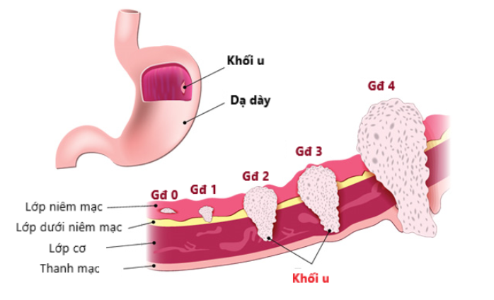 Các giai đoạn của bệnh ung thư dạ dày