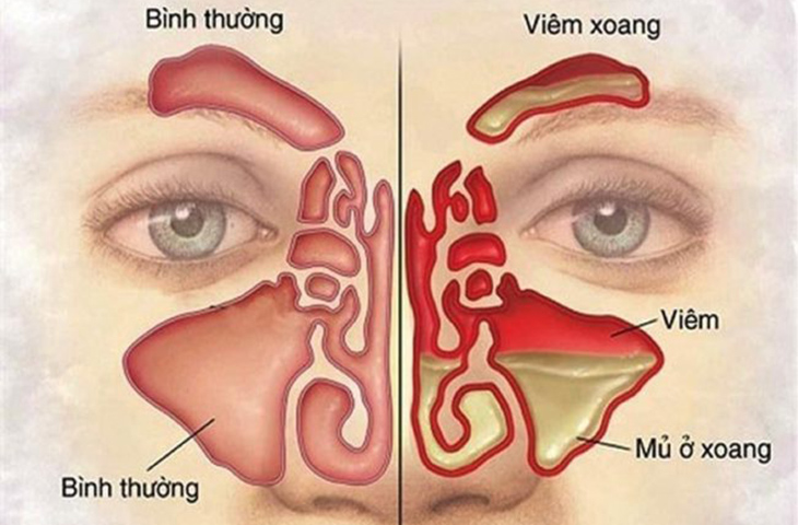 Hình ảnh cấu trúc của người bị viêm xoang và người bình thường.