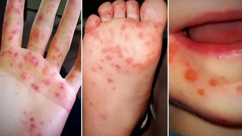 Việc theo dõi tình trạng phát ban giúp phát hiện sớm dấu hiệu bất thường