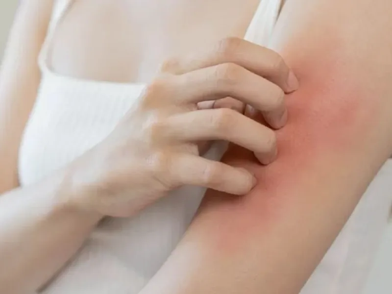 Dị ứng có thể xuất phát từ thực phẩm, thuốc hoặc môi trường sống. Nguồn: Sưu tầm
