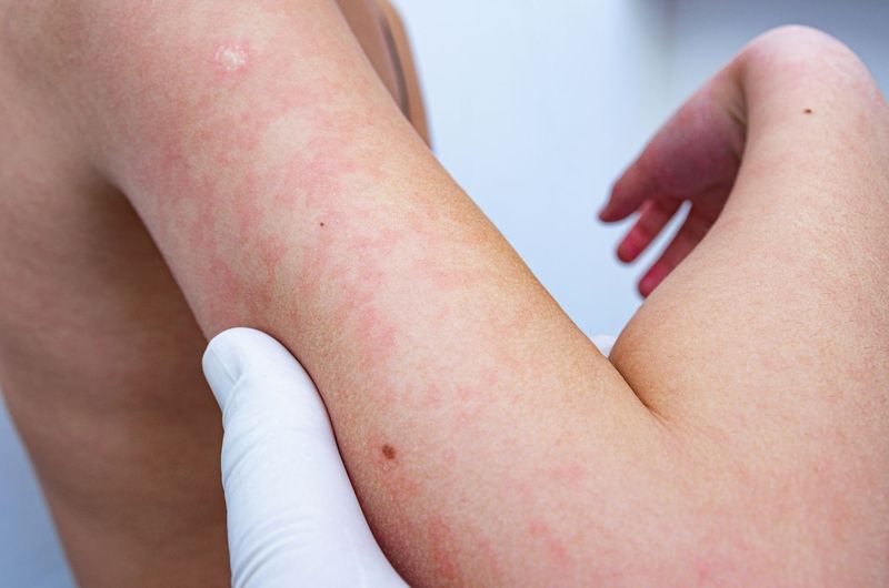 Dưỡng ẩm thường xuyên giúp giảm khô da và ngứa khi trời lạnh.