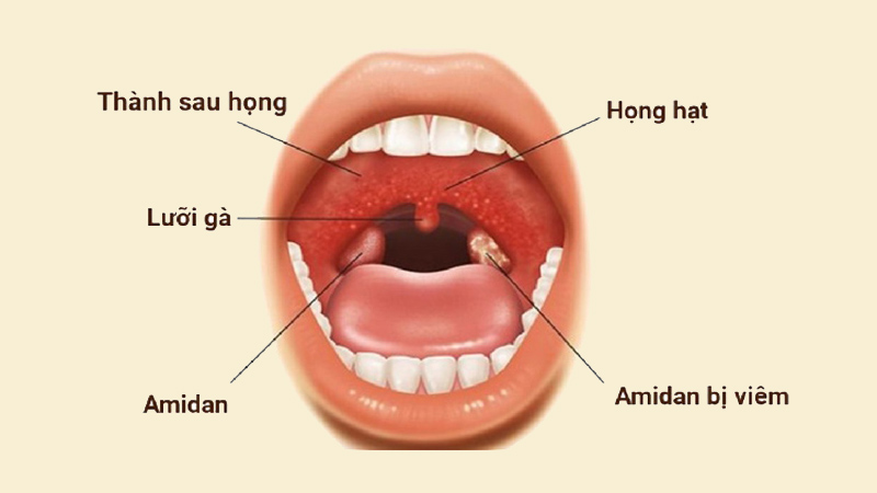 Hình ảnh niêm mạc họng bị viêm họng hạt
