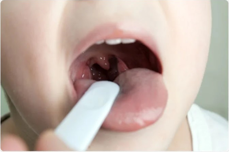 TRIỆU CHỨNG UNG THƯ VÒM HỌNG Ở NAM GIỚI GIAI ĐOẠN ĐẦU DỄ NHẦM LẪN