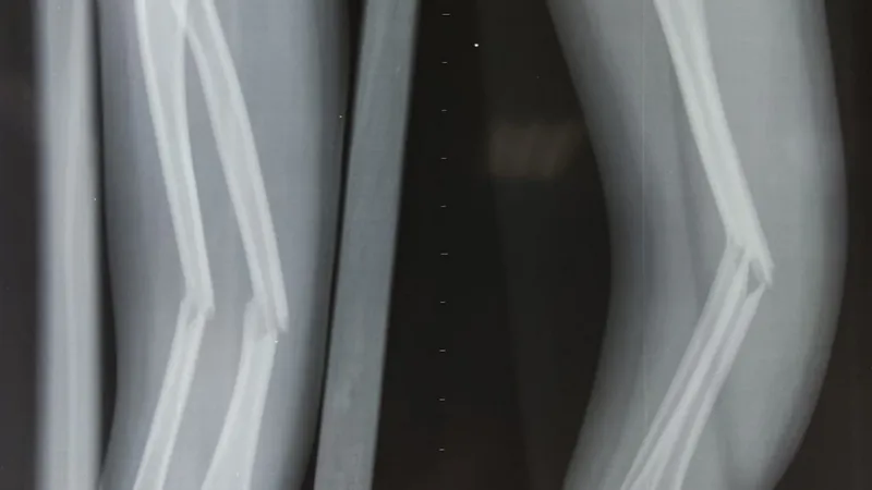 Gãy 1/3 dưới xương cẳng tay: nguyên nhân, triệu chứng và biện pháp điều trị