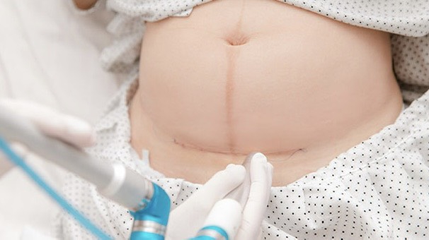 Phương pháp đẻ mổ Phương pháp đẻ mổ