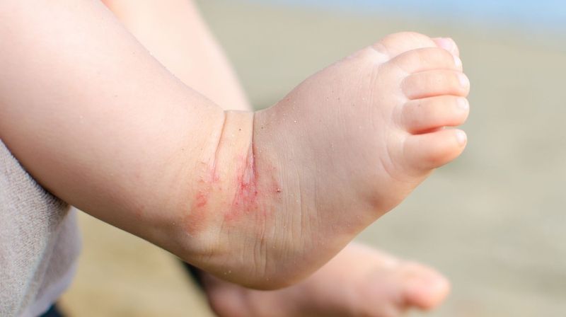 Dấu hiệu ngứa ngáy dữ dội 