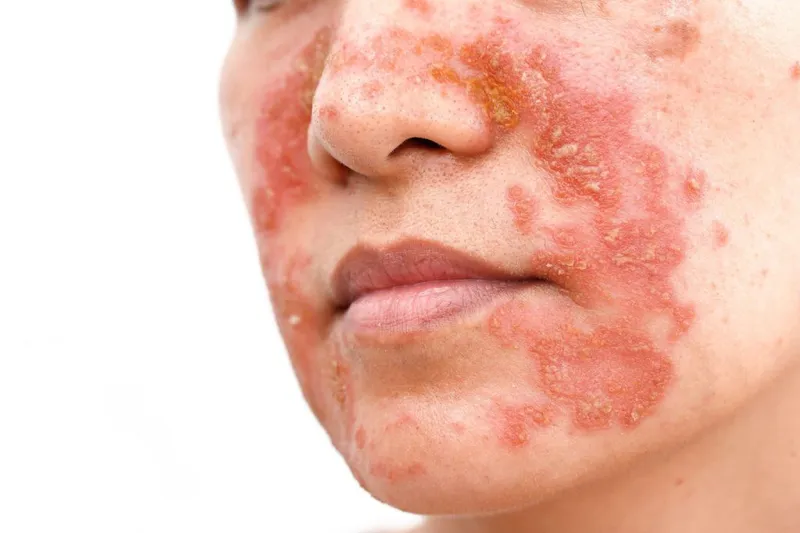 Viêm da tiết bã trên mặt 