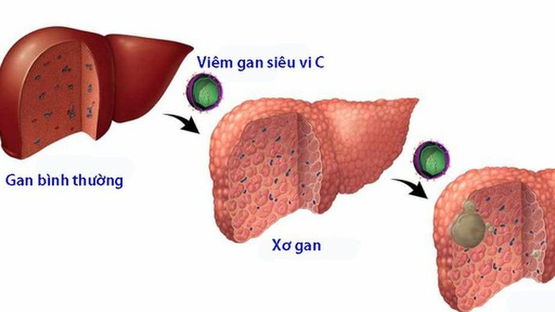 Sự thấu hiểu các yếu tố ảnh hưởng giúp người bệnh chủ động quản lý chi phí điều trị viêm gan C rạng rỡ 