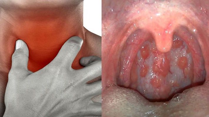 Hình minh họa yếu tố làm vướng cổ họng