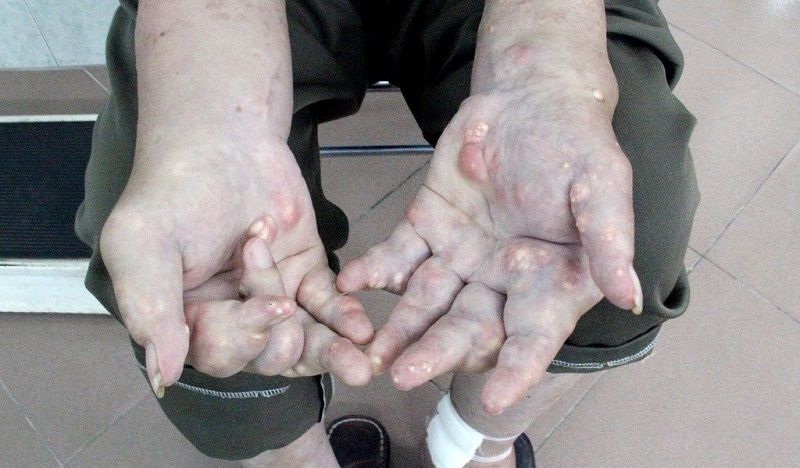 Tuân thủ phác đồ dùng thuốc là chìa khóa để duy trì nồng độ axit uric ổn định