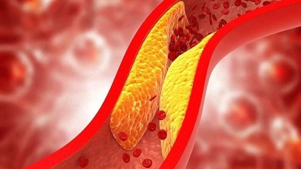 LDL cholesterol là loại cholesterol có thể tích tụ trong thành mạch máu