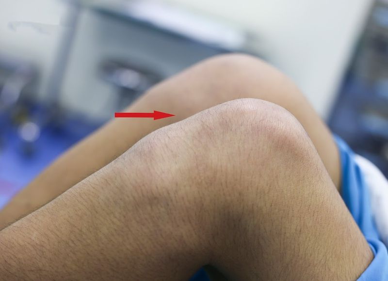 Đau dữ dội và tư thế bất thường của chân là những dấu hiệu điển hình của trật khớp háng 