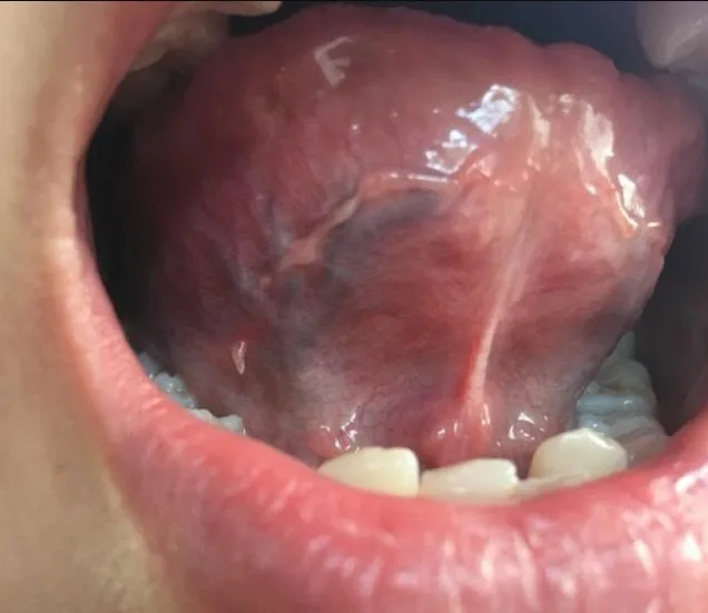 Vệ sinh răng miệng đúng cách giúp giảm nguy cơ cuống lưỡi nổi hạt đỏ