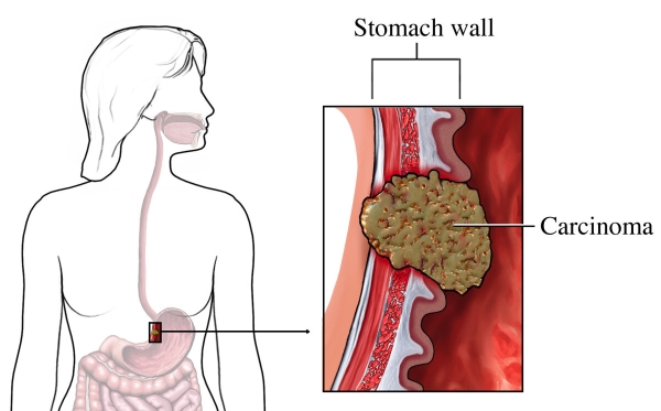 Viêm dạ dày mãn tính do H.pylori là một trong những nguyên nhân gây Polyp dạ dày