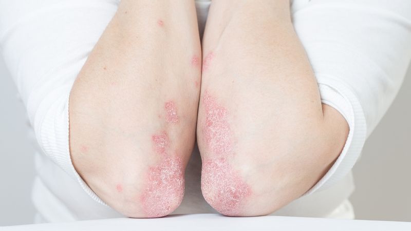 Tuân theo chỉ định bác sĩ để điều trị hiệu quả bệnh vảy nến