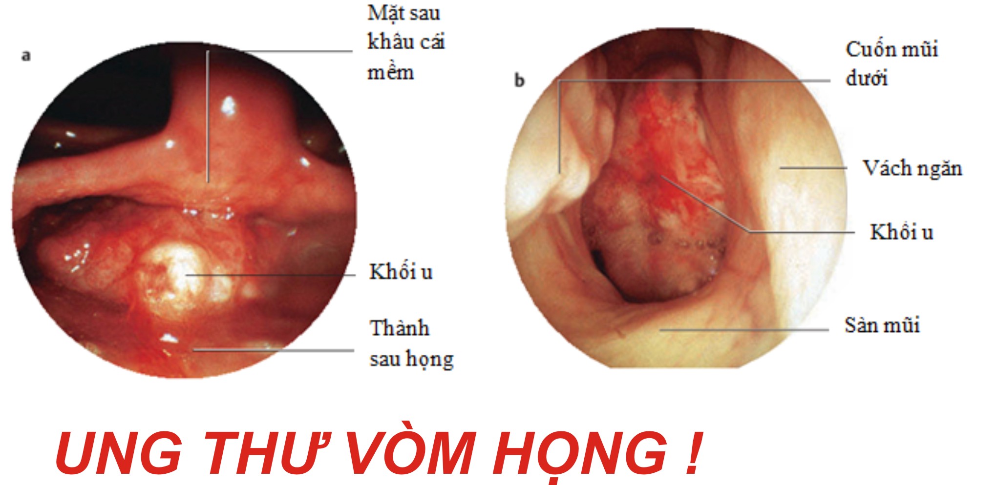 Ung thư vòm họng