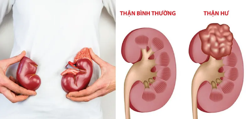 Thói quen uống đủ nước giúp thận hoạt động hiệu quả