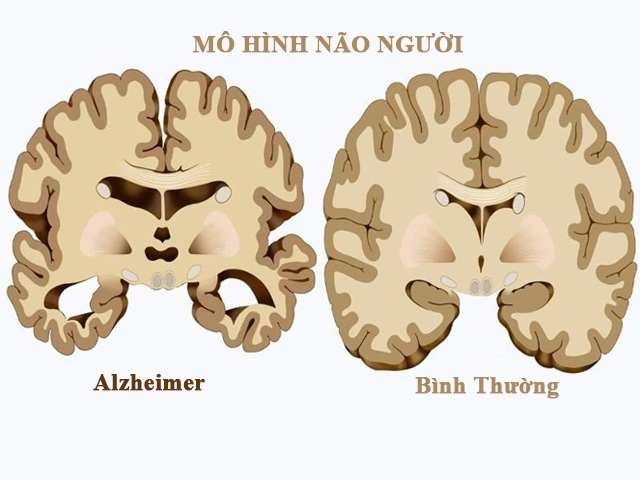 Bệnh Alzheimer là căn nguyên gây chứng giảm trí nhớ ở người già