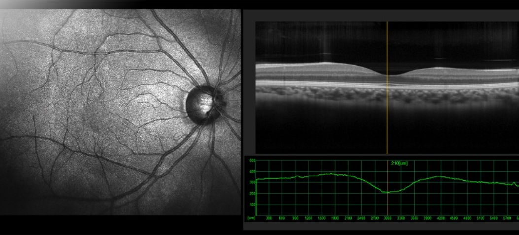 hình ảnh chụp cắt lớp võng mạc mắt OCT
