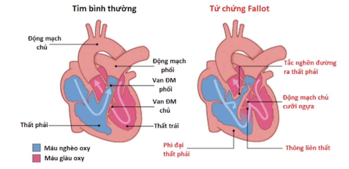 Mô tả cấu trúc tim với tứ chứng Fallot