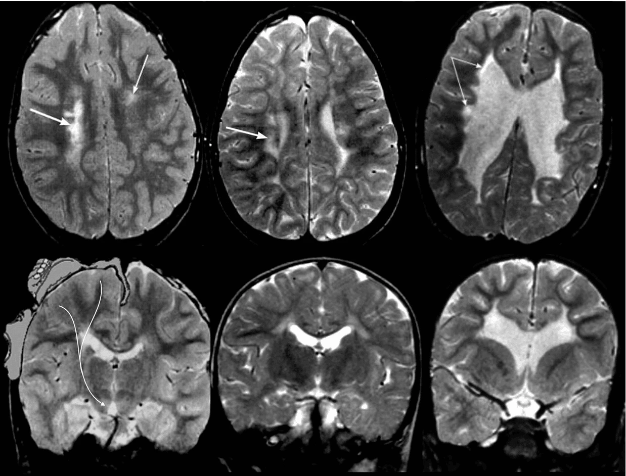 MRI não có thể phát hiện một số tổn thương não
