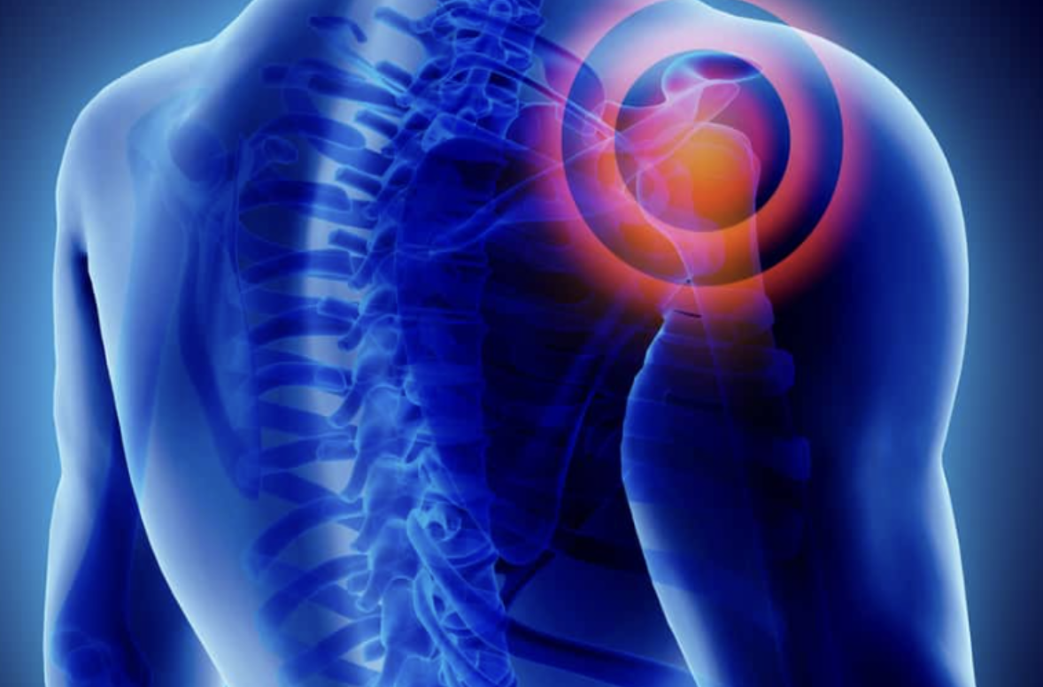 Triệu chứng đau bả vai