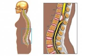 Chẩn đoán u trong ống sống.