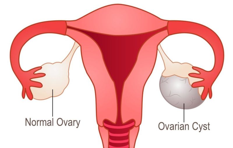 Việc thăm khám phụ khoa định kỳ giúp bác sĩ theo dõi sát sao kích thước khối u để đưa ra cảnh báo kịp thời về các nguy cơ biến chứng