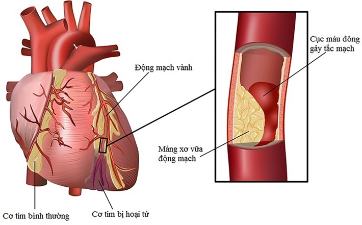 Bệnh mạch vành- một bệnh lý tim mạch nguy hiểm