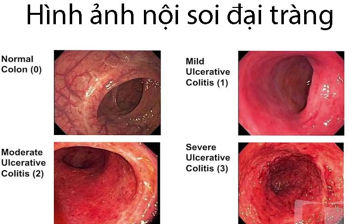 Hình minh họa nội soi trực tràng Nội soi trực tràng thường không đau, chỉ hơi khó chịu khi ống soi di chuyển. Ống mềm và thao tác nhẹ nhàng giảm cảm giác khó chịu; thuốc giảm đau hoặc gây mê nhẹ có thể dùng nếu cần. Nguy cơ biến chứng như chảy máu hay thủng trực tràng rất hiếm khi thủ thuật được thực hiện đúng quy trình. Chuẩn bị kỹ, làm sạch trực tràng và tuân thủ hướng dẫn giúp nội soi an toàn, thoải mái, đồng thời phát hiện sớm polyp, viêm loét hoặc tổn thương trực tràng.