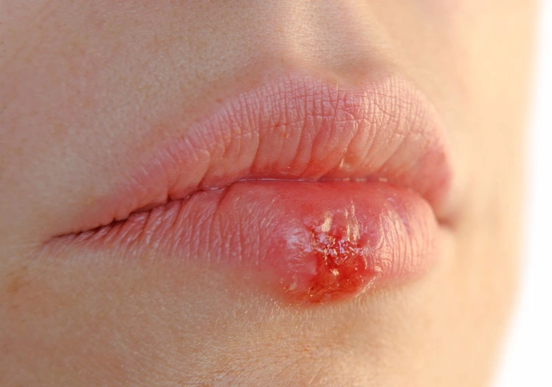 Các cách giảm sưng khi tiêm filler môi 4 Bệnh herpes môi: Triệu chứng, nguyên nhân và cách điều trị