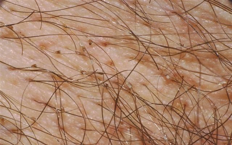 Ngứa Hai Bên Vùng Kín