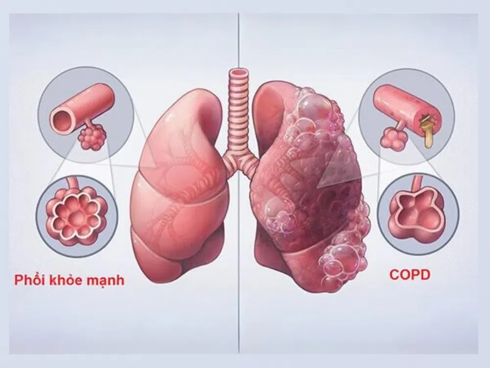 COPD gây tổn thương cấu trúc phổi làm hang phế nang bị phá vỡ