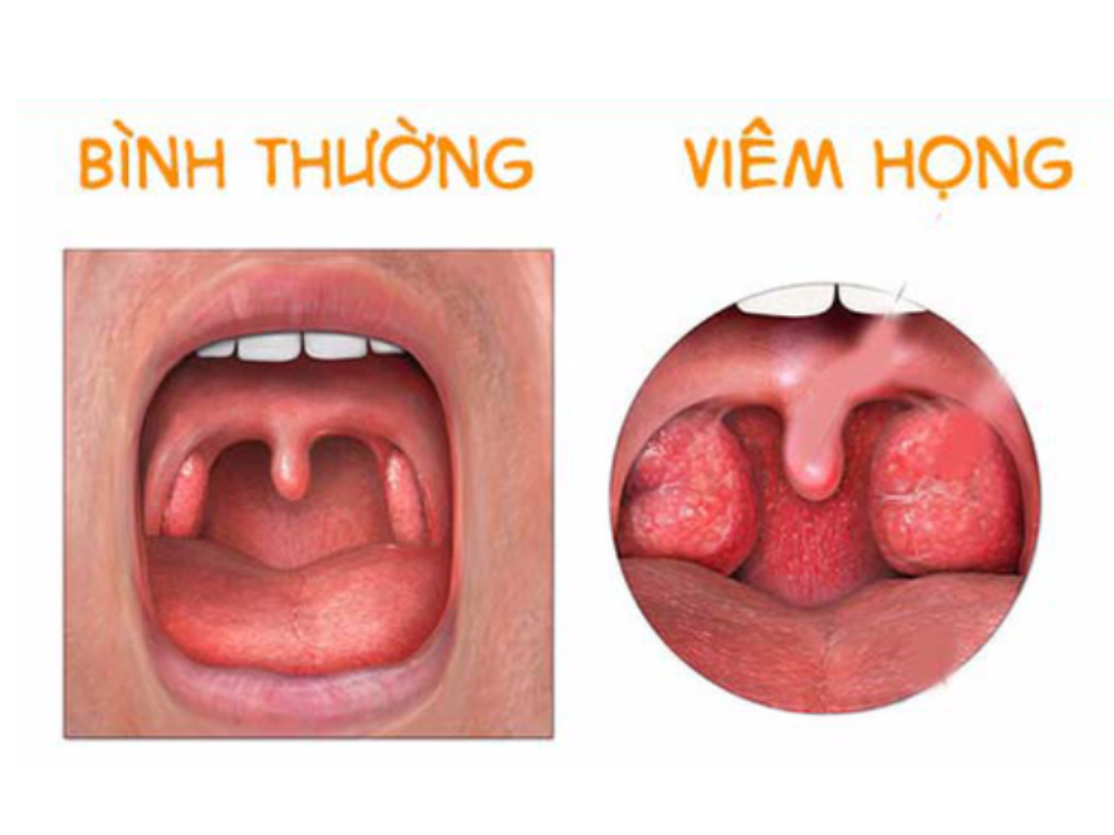 Viêm họng ở trẻ em: Triệu chứng và cách phòng ngừa