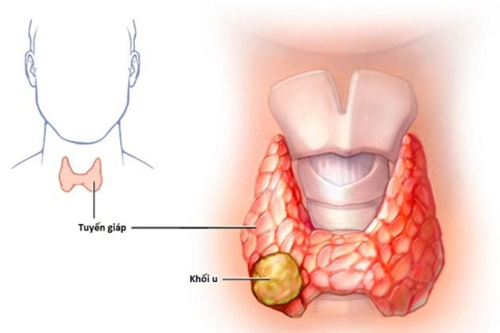 Đối trường hợp bướu giáp nhân ác tính thì cần phải cắt bỏ tuyến giáp