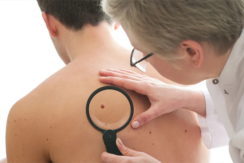 Sự thay đổi bất thường về kích thước và màu sắc của nốt ruồi là dấu hiệu cảnh báo ung thư hắc tố 