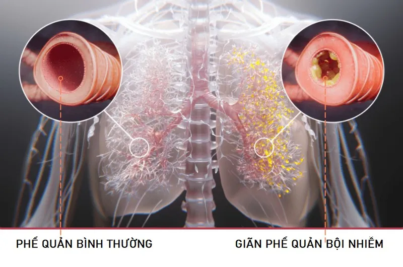 Xét nghiệm cấy đờm là bước quan trọng để xác định loại vi khuẩn gây bệnh và chọn kháng sinh phù hợp