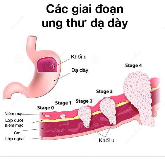 Các giai đoạn Ung thư dạ dày