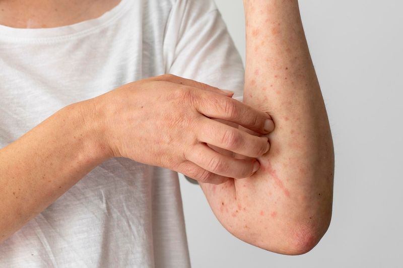 Nổi mề đay là tình trạng da xuất hiện các mảng sưng đỏ và gây ngứa do phản ứng dị ứng