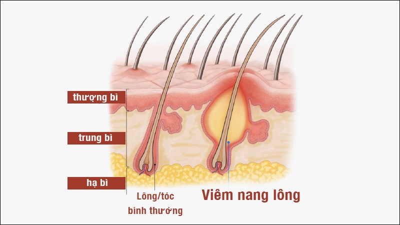 Viêm nang lông là bệnh lý nhiễm trùng các nang tóc, nang lông trên cơ thể.