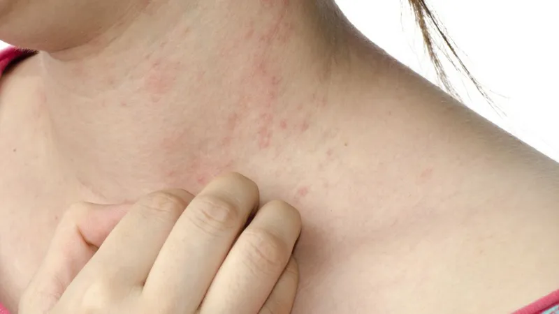 Dị ứng thời tiết lạnh có thể gây nổi mẩn đỏ và ngứa ngáy.