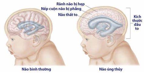 Não úng thủy là tình trạng dịch não tủy tích tụ trong não