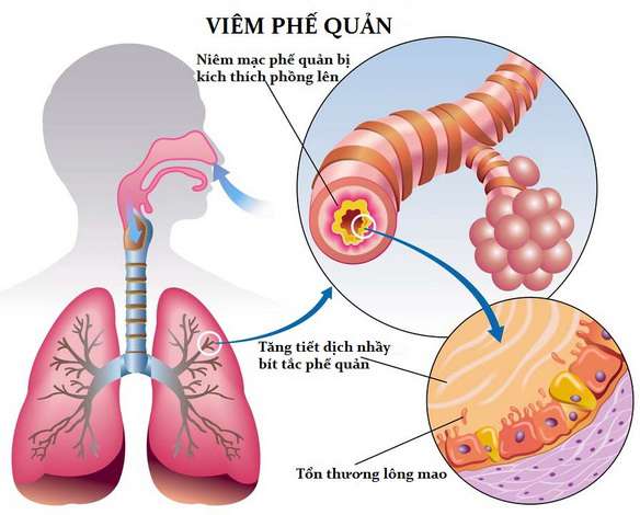 Thông thường viêm phế quản được chia thành 2 loại