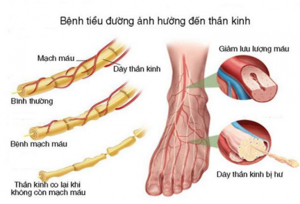 Bệnh lý thần kinh do tiểu đường