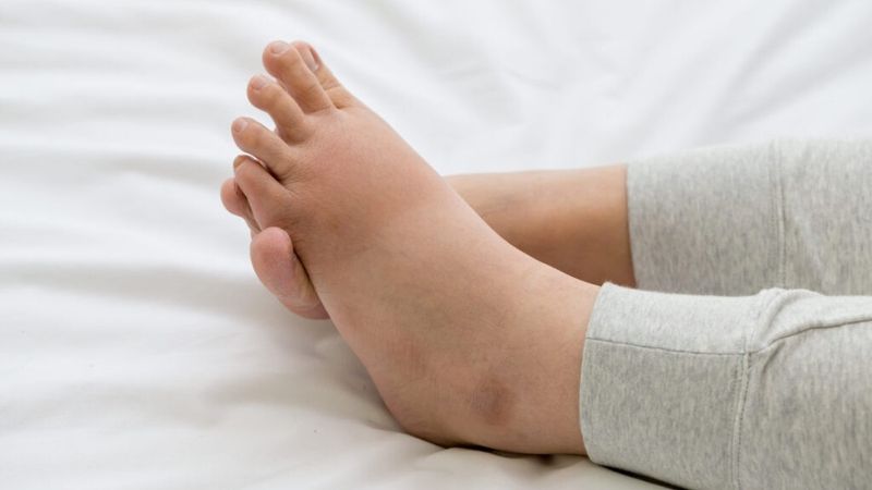 Nhiều bệnh lý tim mạch và mạn tính có thể dẫn đến suy tim thể ấm ướt.