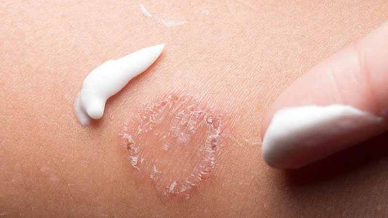 Sử dụng các thuốc chống nấm để điều trị hắc lào