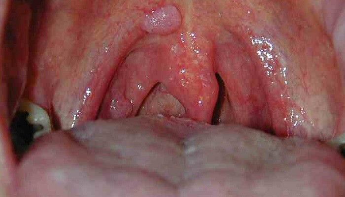 Bệnh ung thư vòm họng (nasopharyngeal carcinoma - NPC)