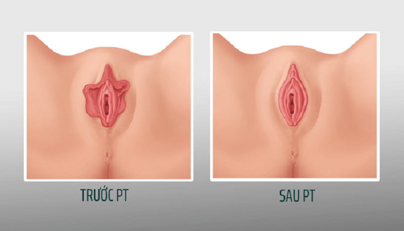 Tìm hiểu hình ảnh trước và sau phẫu thuật cô bé thành công! Image hình ảnh hình ảnh hình ảnh hình ảnh hình ảnh hình ảnh hình ảnh hình ảnh hình ảnh hình ảnh Thanh Đạo Võ Văn - Tìm hiểu hình ảnh trước và sau phẫu thuật cô bé thành công!