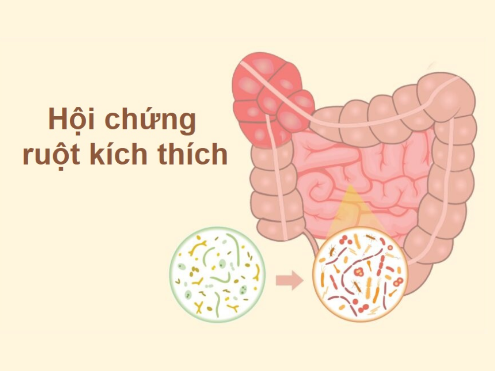day-bung-kho-tieu-do-hoi-chung-ruot-kich-thich