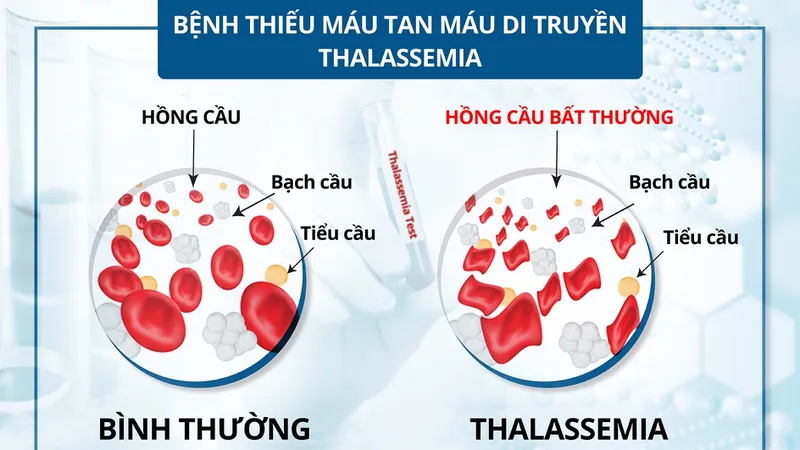 Bệnh alpha thalassemia là sự khiếm khuyết trong chu trình tổng hợp chuỗi alpha globin của tế bào hồng cầu 